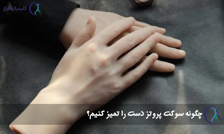 مراقبت مناسب از پروتز دست