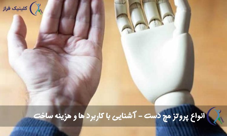 پروتز مچ دست