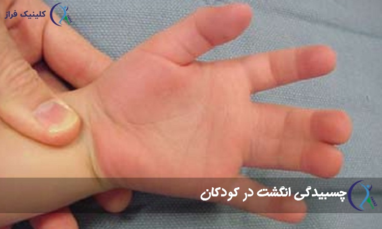 سین‌ داکتیلی در نوزادان