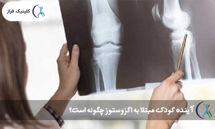 آینده کودک مبتلا به اگزوستوز چگونه است؟