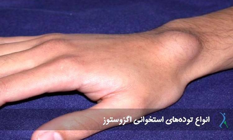 انواع تودههای استخوانی اگزوستوز