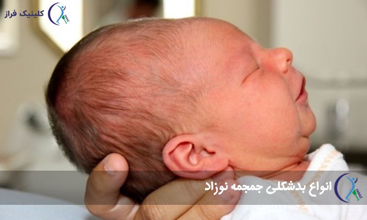 انواع بدشکلی جمجمه نوزاد