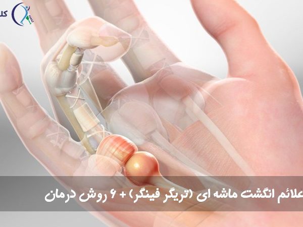 انگشت ماشه‌ ای
