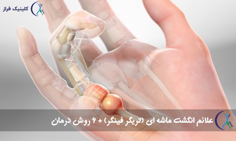 انگشت ماشه‌ ای
