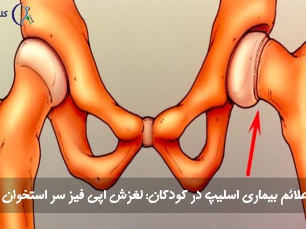 بیماری اسلیپ در کودکان