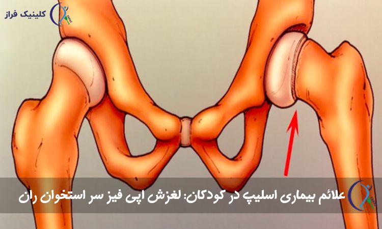 بیماری اسلیپ در کودکان