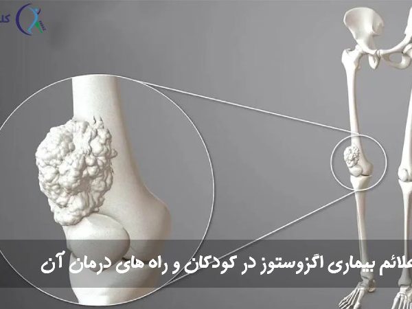 بیماری اگزوستوز