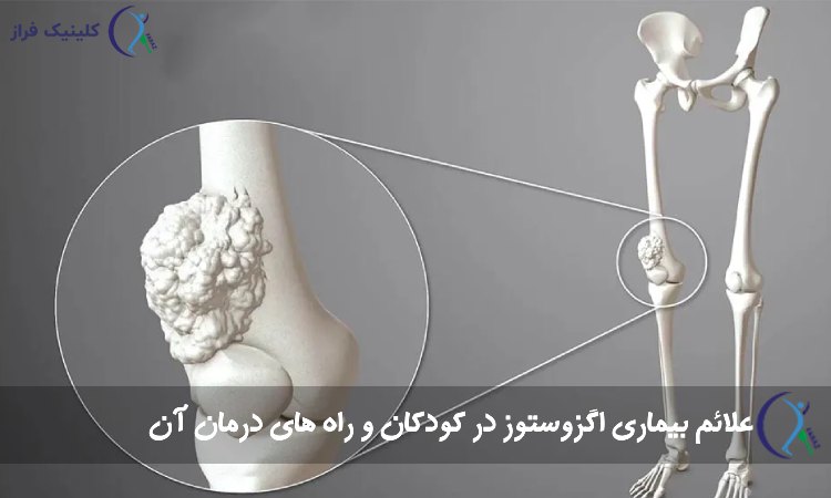 بیماری اگزوستوز