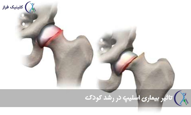تاثیر بیماری اسلیپ در رشد کودک