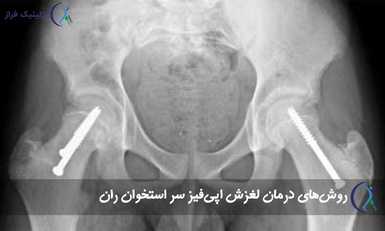 درمان لغزش اپی‌فیز سر استخوان ران