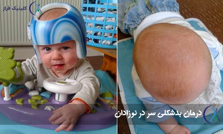 روش‌های درمان بدشکلی جمجمه نوزاد