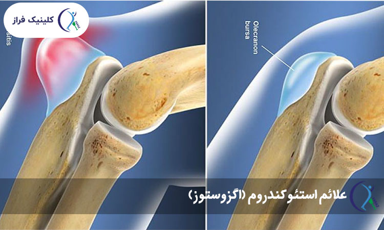 علائم استئوکندروم