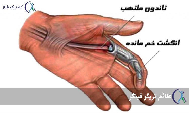 علائم انگشت ماشه‌ای