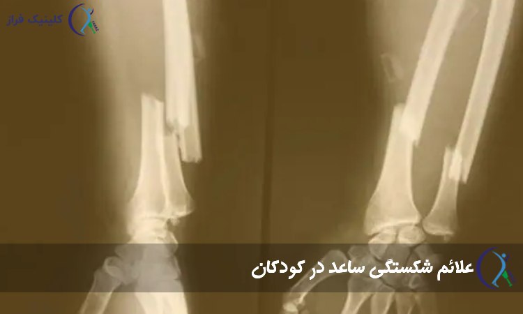 علائم شکستگی ساعد در کودکان 