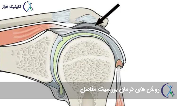 روش های درمان بورسیت مفاصل