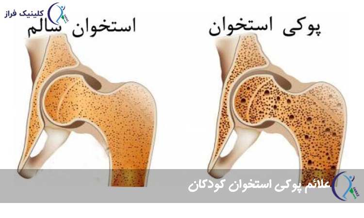 علائم پوکی استخوان کودکان