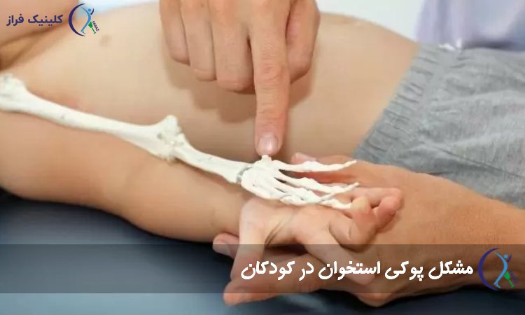 پوکی استخوان در کودکان