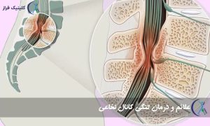 تنگی کانال نخاعی