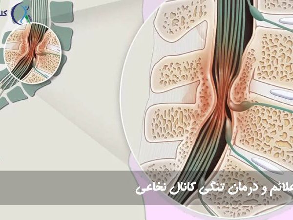 تنگی کانال نخاعی