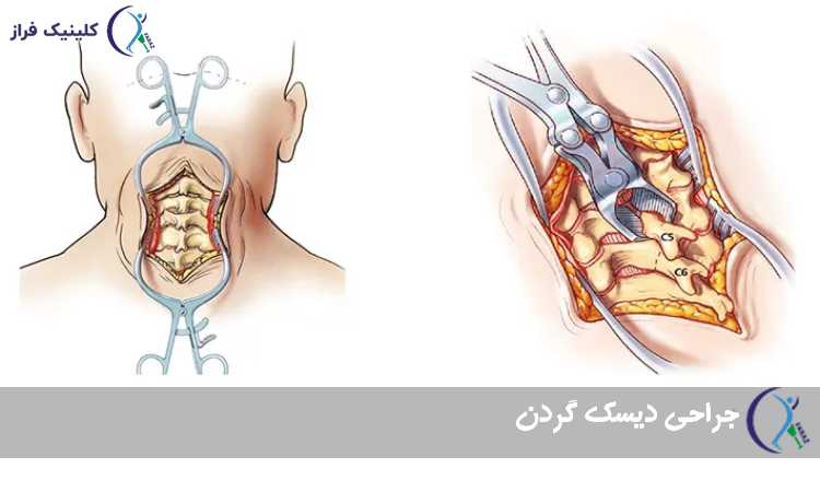 جراحی دیسک گردن