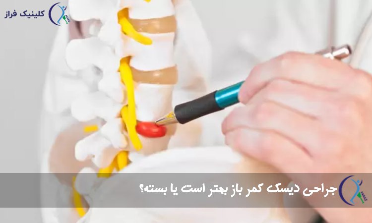 جراحی دیسک کمر باز بهتر است یا بسته؟