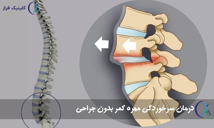 درمان سرخوردگی مهره کمر بدون جراحی