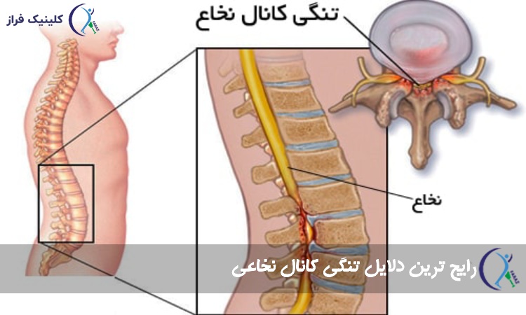 رایج ترین دلایل تنگی کانال نخاعی در زنان و مردان