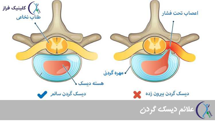 علائم دیسک گردن