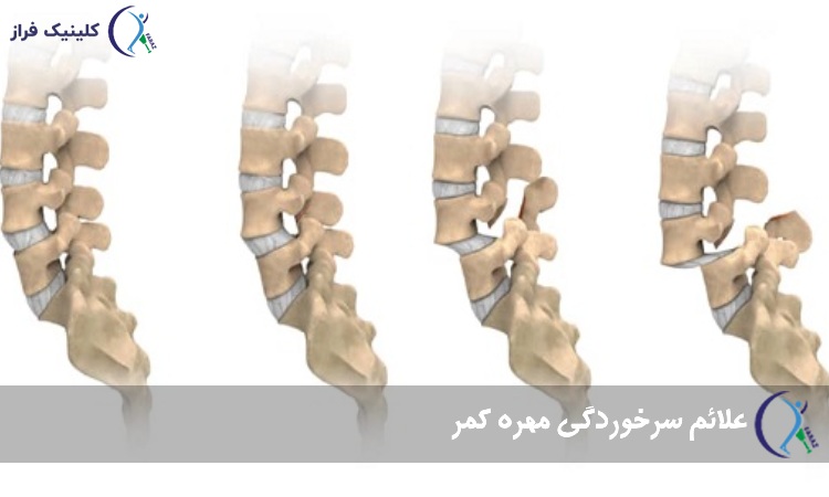 علائم سرخوردگی مهره کمر
