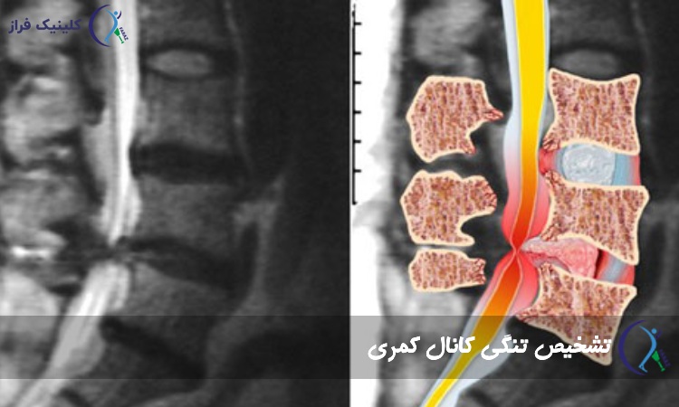 عکس تنگی کانال نخاعی