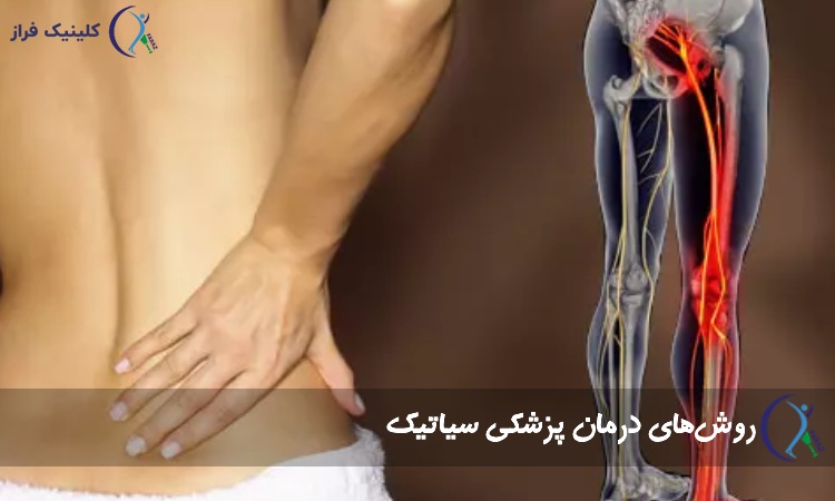 درمان پزشکی سیاتیک