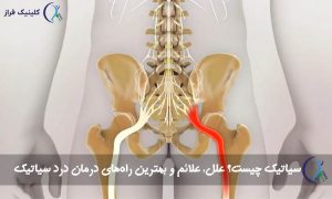 سیاتیک چیست؟ علل، علائم و بهترین راه‌های درمان درد سیاتیک