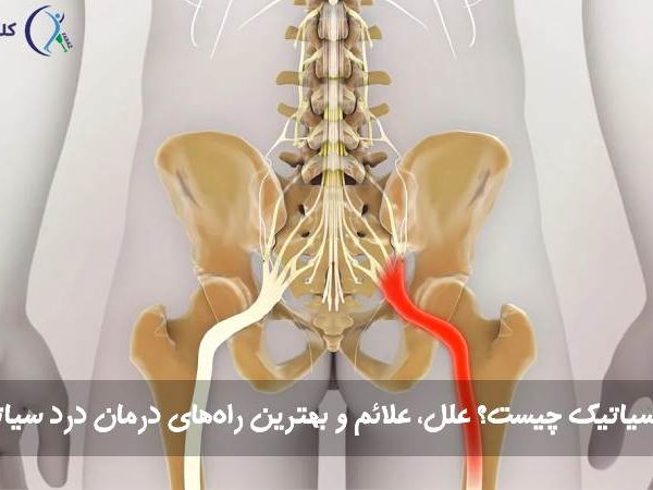 سیاتیک چیست؟ علل، علائم و بهترین راه‌های درمان درد سیاتیک