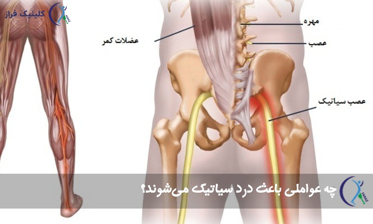دلایل ایجاد سیاتیک