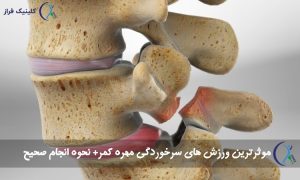 ورزش سرخوردگی کمر