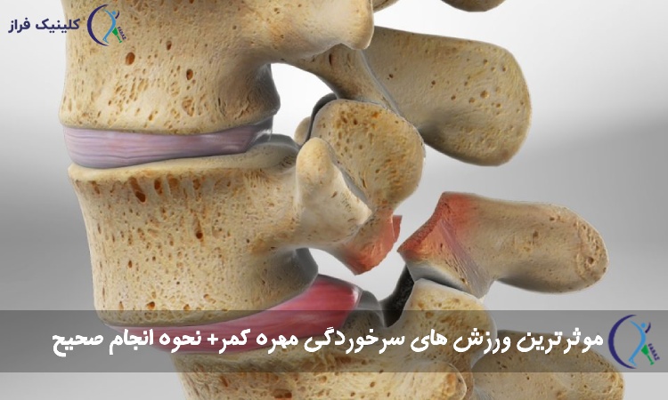 ورزش سرخوردگی کمر