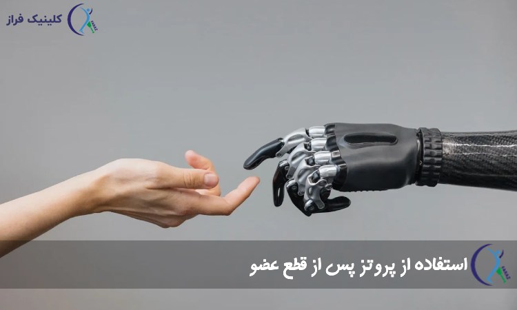 استفاده از پروتز پس از قطع عضو