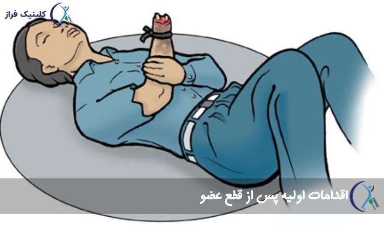 اقدامات اولیه پس از قطع عضو