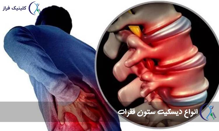 انواع دیسکیت ستون فقرات