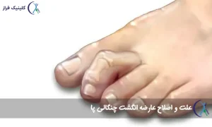انگشت چنگالی پا