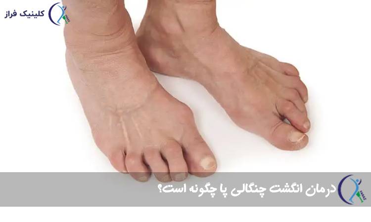 درمان انگشت چنگالی پا