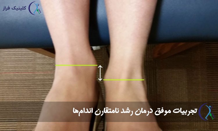 تجربیات موفق درمان رشد نامتقارن اندام‌ها