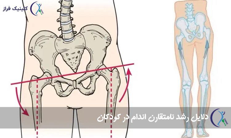 دلایل رشد نامتقارن اندام‌ در کودکان