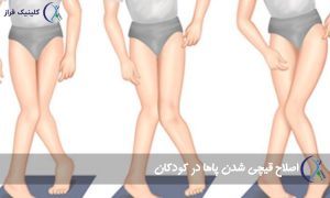 قیچی شدن پاها در کودکان