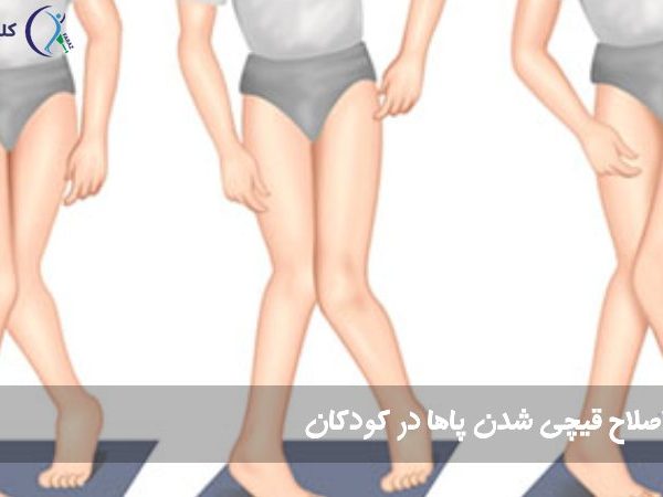 قیچی شدن پاها در کودکان