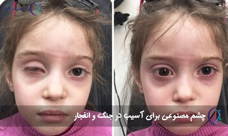 چشم مصنوعی برای آسیب در جنگ و انفجار