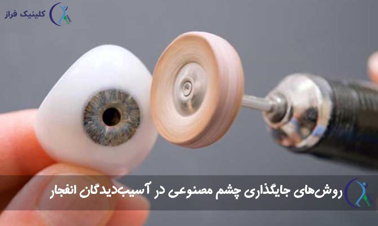 روشهای جایگذاری چشم مصنوعی در آسیبدیدگان انفجار