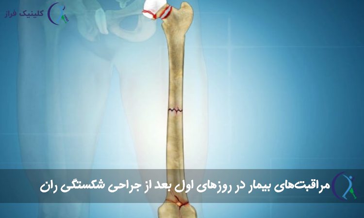 شکستگی ران