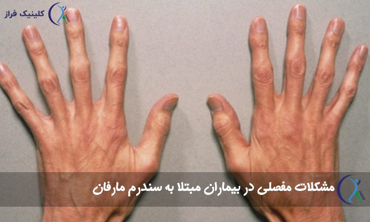 مشکلات مفصلی در بیماران مبتلا به سندرم مارفان