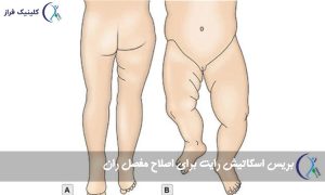 بریس اسکاتیش رایت برای اصلاح مفصل ران